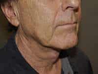 Neck Lift