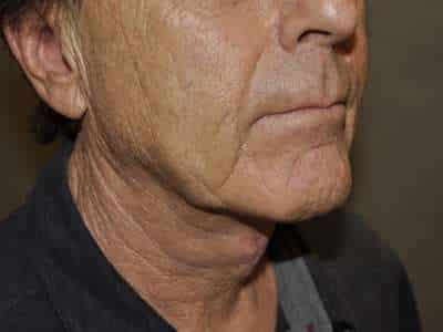 Neck Lift