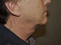 Neck Lift