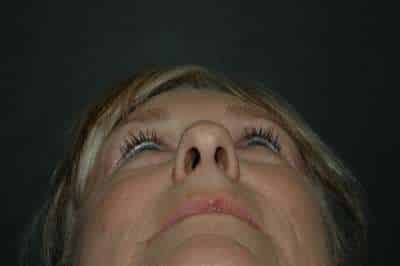 Rhinoplasty
