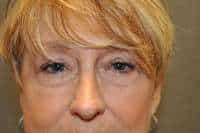 Rhinoplasty