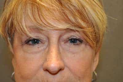 Rhinoplasty