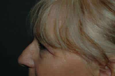 Rhinoplasty