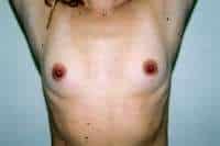 Breast Augmentation