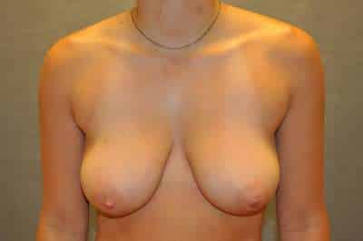 Breast Reduction
