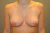 Breast Reduction