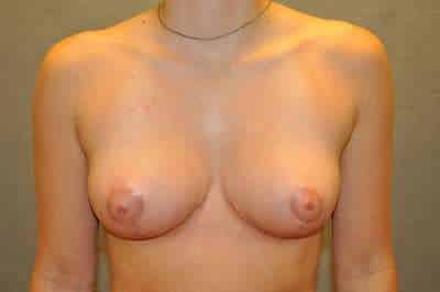 Breast Reduction