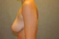 Breast Reduction