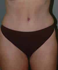 Liposuction