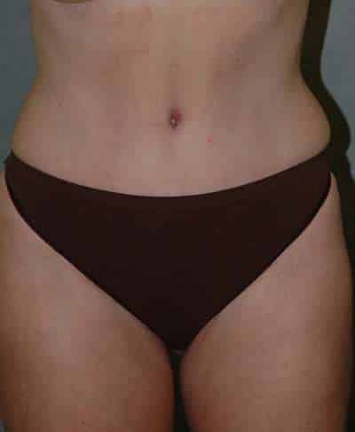 LIPOSUCTION Before and After Results