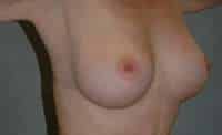 Breast Augmentation
