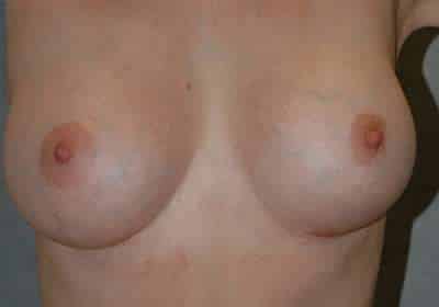 Breast Augmentation