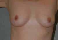 Breast Augmentation