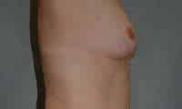 Breast Augmentation