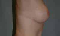 Breast Augmentation