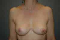 Breast Implant Removal