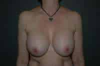 Breast Implant Removal