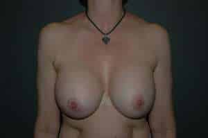 Breast Implant Removal