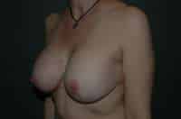 Breast Implant Removal