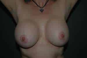 Breast Implant Removal