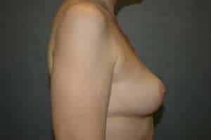 Breast Implant Removal
