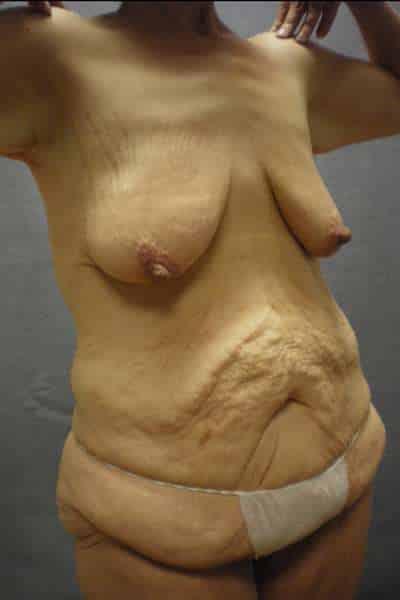 Abdominoplasty