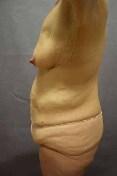 Abdominoplasty