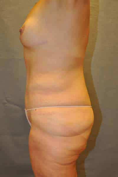 Abdominoplasty