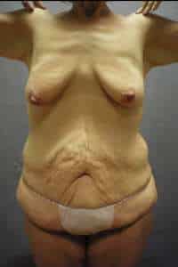 Abdominoplasty
