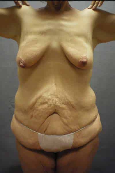 Abdominoplasty