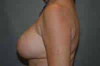 Breast Lift