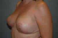 Breast Lift