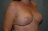 Breast Lift