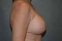 Breast Lift