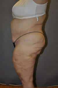 Panniculectomy