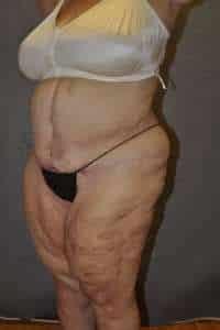 Panniculectomy