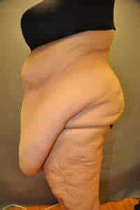 Panniculectomy