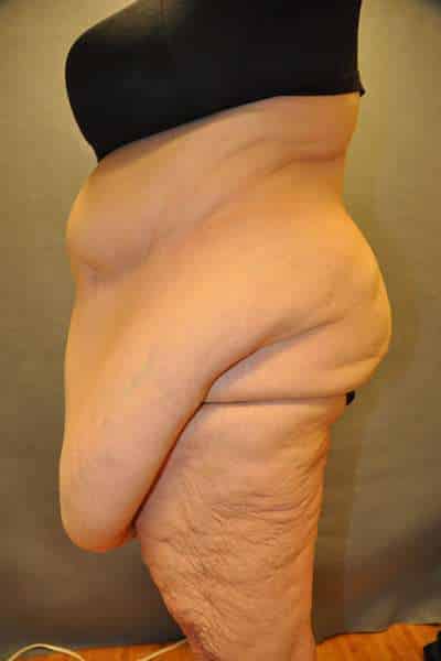 Panniculectomy