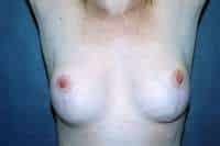 Breast Lift