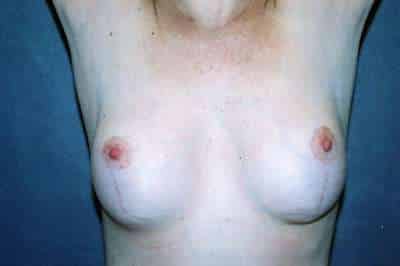 Breast Lift