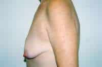 Breast Lift