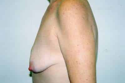 Breast Lift