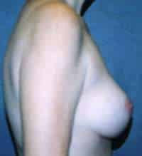 Breast Lift