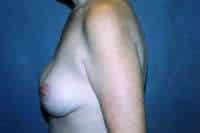Breast Lift