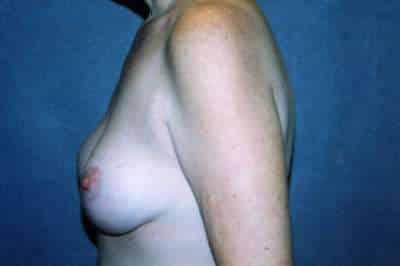 Breast Lift