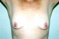 Breast Lift