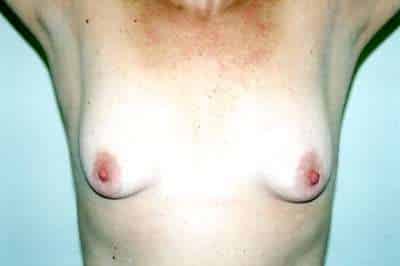 Breast Lift