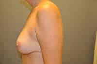 Breast Lift