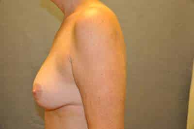 Breast Lift