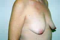 Breast Lift